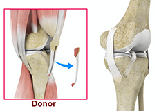 Bone-Patellar Tendon-Bone (BPTB) Allograft