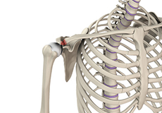 AC Joint Separation