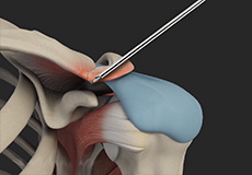 AC Joint Stabilisation