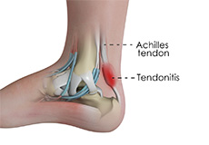 Achillles Tendinitis