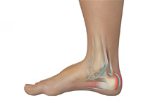 Achilles Tendon Bursitis