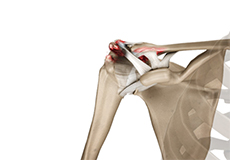 Acromioclavicular (AC) Joint Osteoarthritis