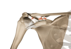 AC Joint Dislocation/Acromioclavicular Joint Dislocation