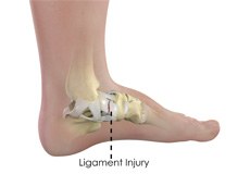 Ankle Ligament Injury