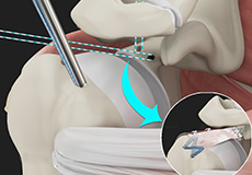 Arthroscopic Superior Capsular Reconstruction (SCR)