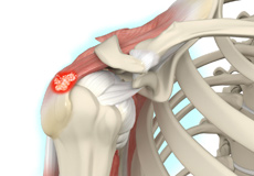 Calcification Tendinitis