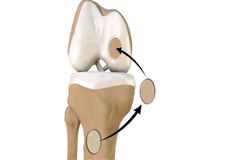 Chondroplasty