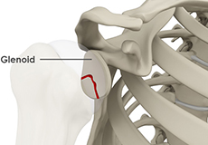 Glenoid Fractures