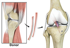 Hamstring Allograft