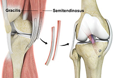 Hamstring Autograft