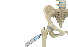 Intra-Articular Joint Injections