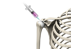 Intraarticular Shoulder Injection