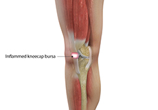 Kneecap Bursitis