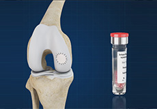 Autologous Chondrocyte Implantation