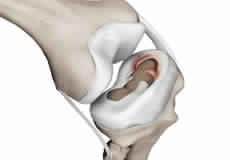 Meniscal Tears