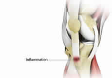 Osgood-Schlatter Disease