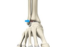 Osteochondral Injuries of the Ankle