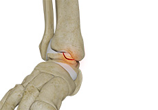 Osteochondral Lesions of the Ankle