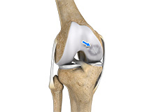 Osteochondritis Dissecans of the Knee