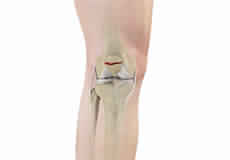 Patella  Fracture