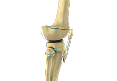 Tibial Tubercle Transfer