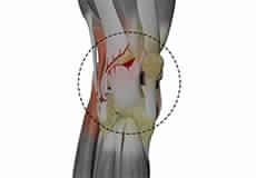 Posterolateral Instability