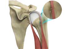 Proximal Humerus Fractures