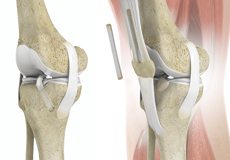 Quadriceps Tendon Autograft for Anterior Cruciate Ligament Reconstruction