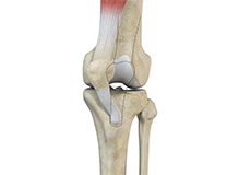 Recurrent Patella Dislocation