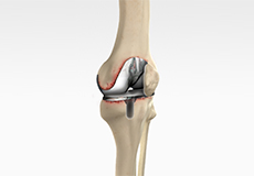 Revision Knee Ligament Reconstruction