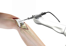 Robotic Assisted Partial Knee Surgery