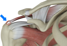 Rotator Cuff Calcification