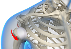 Multidirectional Instability of the Shoulder