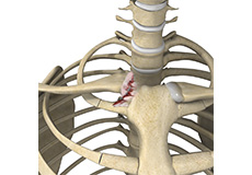 Sternoclavicular Joint Reconstruction