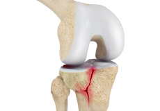 Tibial Plateau  Fracture