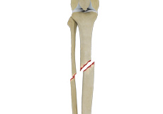 Tibial Shaft  Fracture