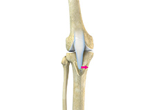 Tibial Tubercle Osteotomy