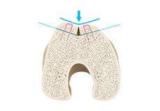 Trochleoplasty