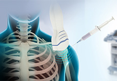 Ultrasound-Guided Shoulder Injections